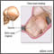 Fetal head molding